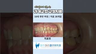 #과개교합 #치아교정과정 #인천치과 #청라치과 #치과 #인비절라인 #치아교정잘하는곳