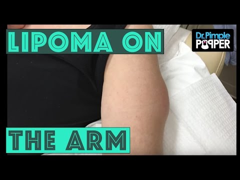 A-Lipoma-International-on-the-Arm!