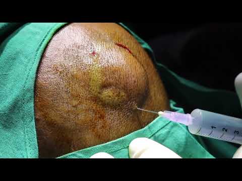 Videó: Lipomatosis - Kezelés, Máj és Bőr Lipomatosis