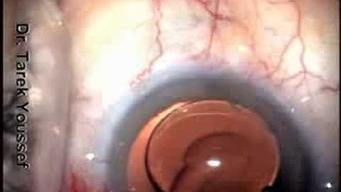 Cut Trailing haptic Explanted and reimplanted