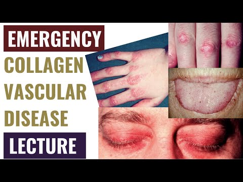 Collagen vascular disease and emergency presentations - Detailed explanation - Emergency Medicine