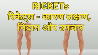 रिकेट्स - कारण लक्षण, निदान और उपचार | rickets in hindi screenshot 4