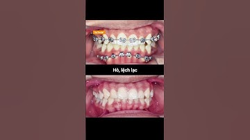 Cận cảnh tiến trình niềng răng hô và lệch lạc