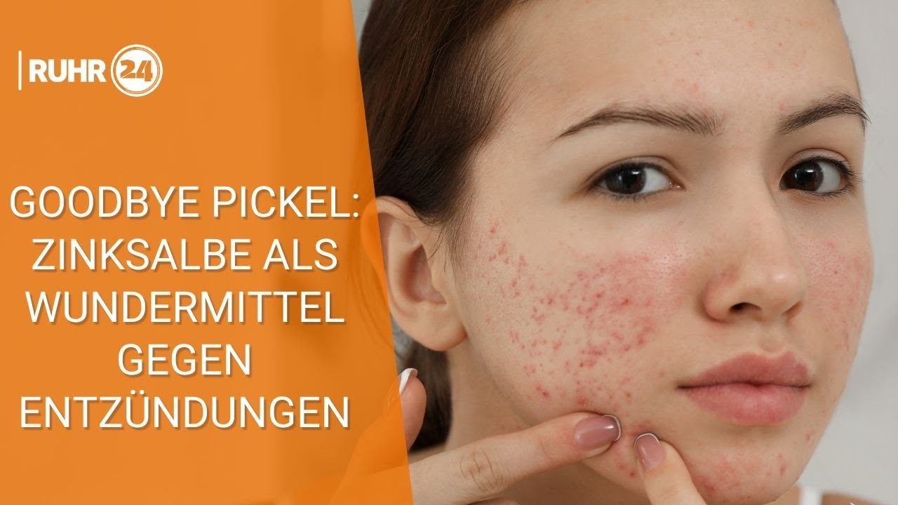 Erstaunlich Zinksalbe Rossmann Pickel Fotos