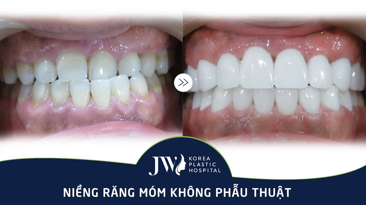 Điều trị hàm móm KHÔNG PHẪU THUẬT - Kết quả bất ngờ - youtube
