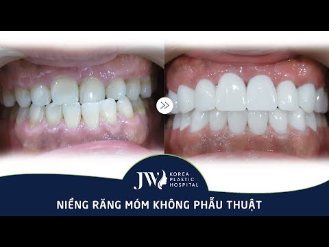 Video Điều trị hàm móm KHÔNG PHẪU THUẬT - Kết quả bất ngờ - youtube