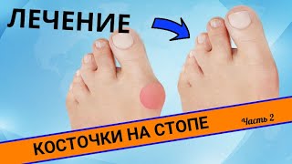 КАК ВЫЛЕЧИТЬ БОЛЬ В СТОПЕ? Косточки на стопе (Часть 2)