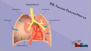 Penetrating Chest Trauma Case Study