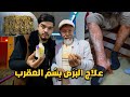 علاج البرص بـ سم العقرب القاتل في افغانستان Treatment With Scorpion In Afghanistan 