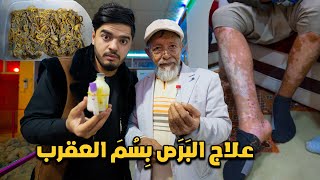 علاج البرص بـ سم العقرب القاتل ? في افغانستان | Treatment with scorpion in Afghanistan