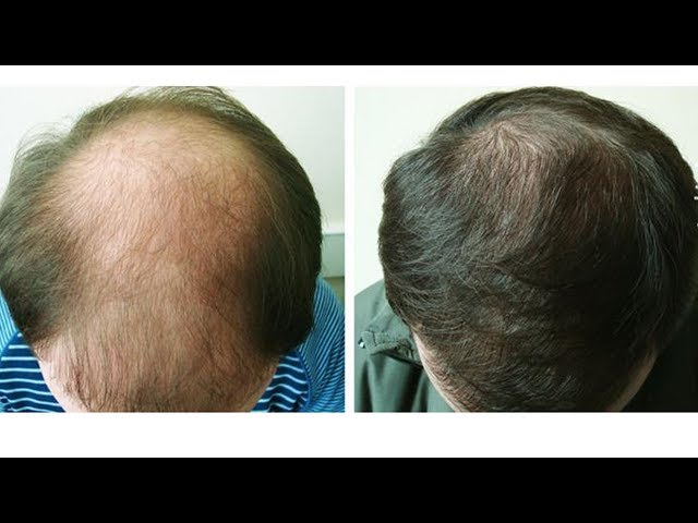 Перестали расти волосы посередине лобка