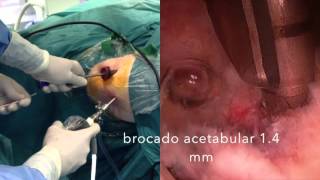 ARTROSCOPIA DE CADERA | SUTURA labrum mas BURSECTOMIA (trocanteritis) #SportmeSevilla