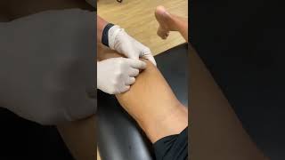 Dry needling for tight calves screenshot 5