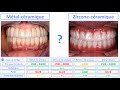 All on 4 : Métal-Céramique ou Zircone-Céramique ?
