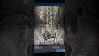 IVP(Intravenous Pyelography) views from reference image to the end#xray #anatomy #radiology