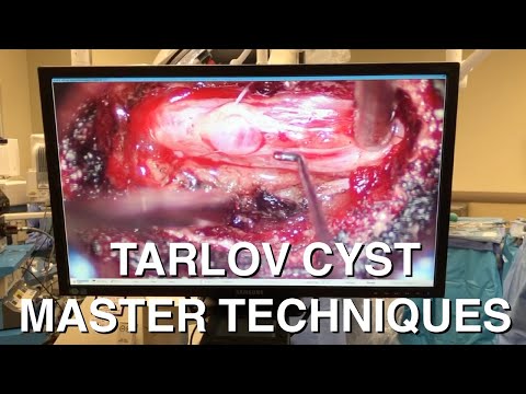 Tarlov Cyst Excision Master Techniques in Minimally Invasive Spine Surgery