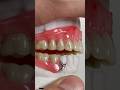 Wax try-in that we just completed for Dr. Umair Waheed in Michigan
