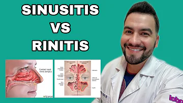 ¿Cuál es la diferencia entre sinusitis y rinitis?