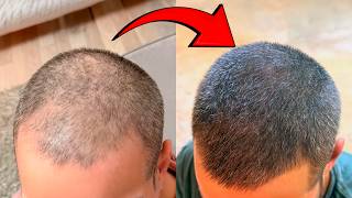 Así Recuperé El Pelo En Las Entradas (Sin Injerto)