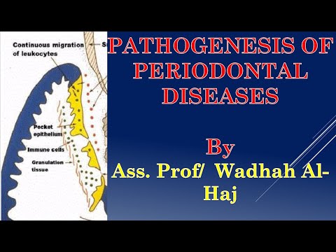 9- Pathogenesis of periodontal diseases - Dr Wadhah Periodontology lectures. د/ وضاح الحاج