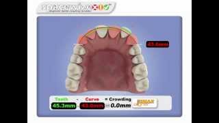 Spacewize: Dental Crowding Calculator