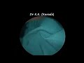 Both Ear Difficult Earwax Removal : Narrow Hairy Ear Canal with Massive Stick Earwax