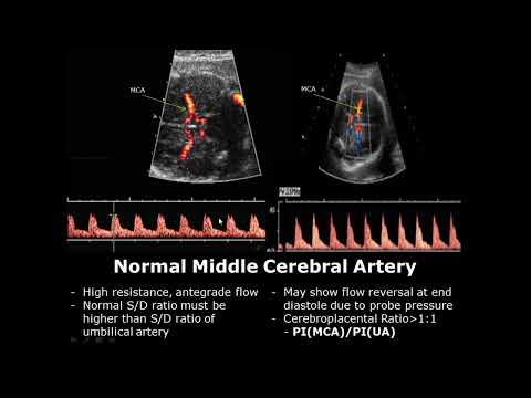 Fetal Middle Cerebral