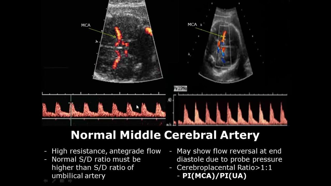 fetal-middle-cerebral-artery-doppler-ultrasound-normal-vs-abnormal