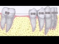 Gota #14 - COMO ACONTECE A MOVIMENTAÇÃO DENTÁRIA ORTODÔNTICA?