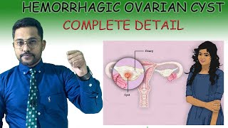 HEMORRHAGIC OVARIAN CYST Treatment screenshot 4