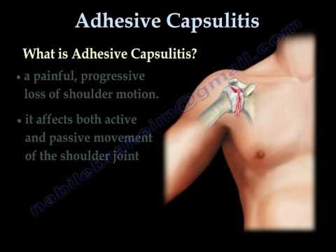 Adhesive Capsulitis ,frozen shoulder. - Everything You Need To Know - Dr. Nabil Ebraheim