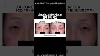 레이저로 아토피를 치료한다? 아토피 완치, 후기를 통해 증명해드리겠습니다! #shorts