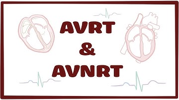AVRT & AVNRT