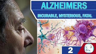 Causes of Alzheimers (1)