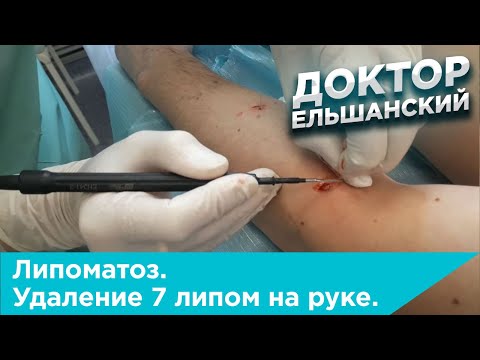 Липоматоз. Удаление 7 липом на руке.