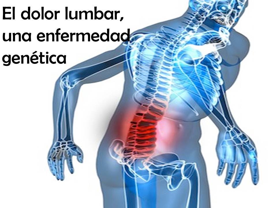 Dolor Lumbar Una Enfermedad Genetica