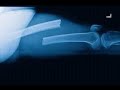 Самый подробный обзор видео . Остеосинтез гибкими титановыми стержнями перелома бедренной кости.