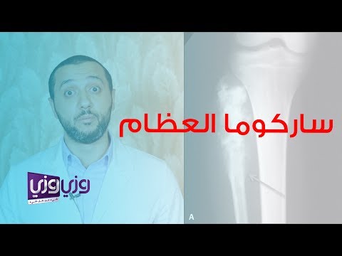 ما هي ساركوما العظام وطريقة تشخيصه وعلاجه