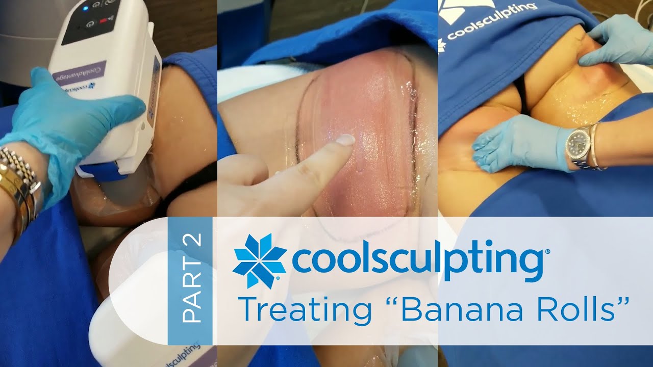 Banana Roll Butt Fat Removal With Coolsculpting