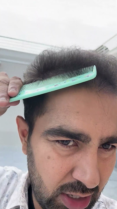 Day 8: Hair Fall Band Ho Gaya! | Androgenic Alopecia Khatam 💪