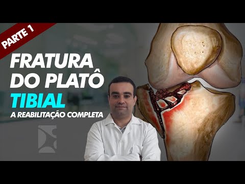 Vídeo: Maneiras simples de diagnosticar e tratar uma fratura do planalto tibial