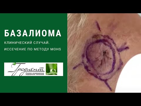 Иссечение базальноклеточного рака кожи по методу MOHS. Клинический случай.