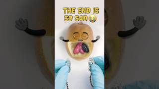 Mr. Kiwi Fruit Surgery goes Deadly wrong😭💔 - Lung Transplant #fruitsurgery #shorts #foodsurgery