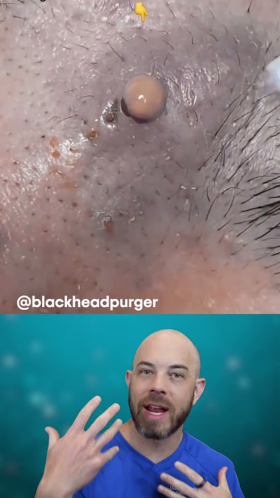 Watch out for the ⚠️DANGER ZONE⚠️ when popping! (credit: @blackheadpurger on TT) #fyp
