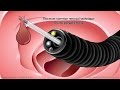 What happens during and after a colonoscopy