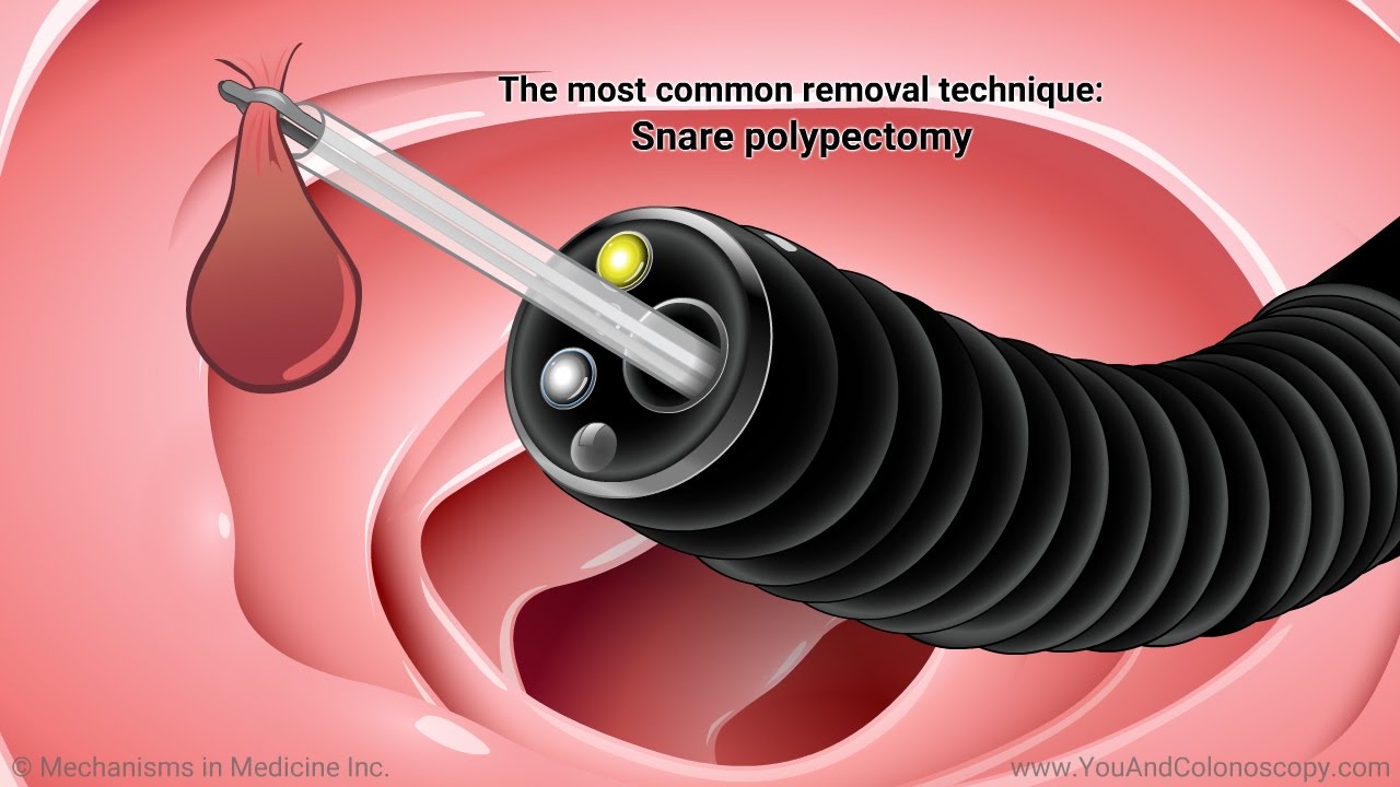 What happens during and after a colonoscopy