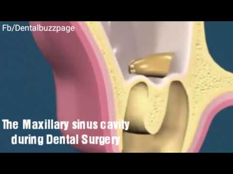 This is How Dislocated Wisdom Tooth in Maxillary sinus is Removed