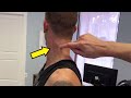 Massive neck knot sends pain down his arm  thoracic outlet syndrome  cracks  deep massage