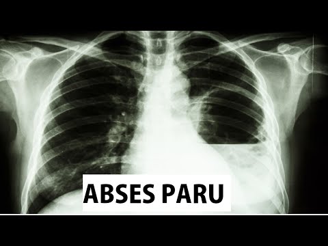 Abses Paru | Batuk Berdahak | Sesak | Sistem Pernafasan