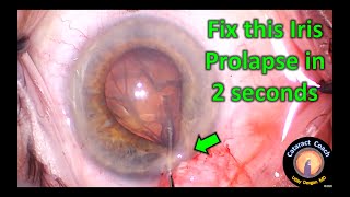 Fix this iris prolapse during cataract surgery in 2 seconds